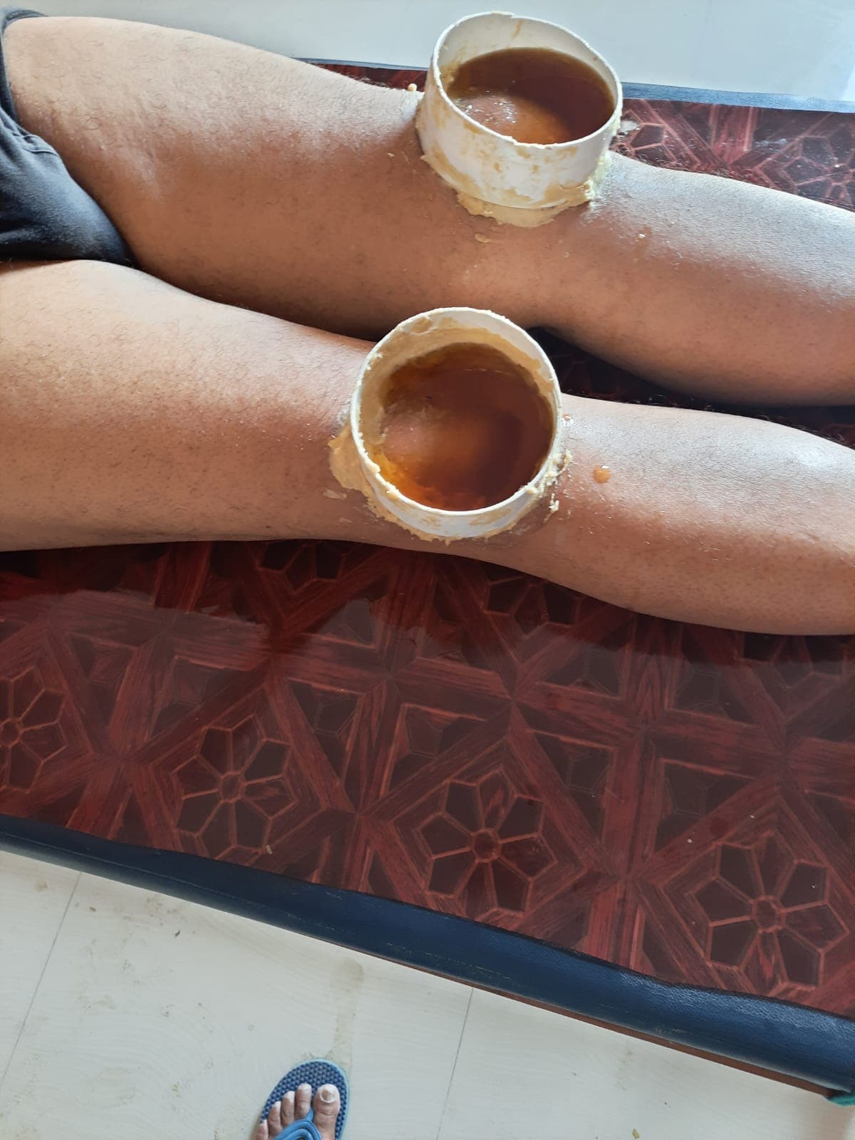 Janu Basti both knees oil pooling therapy